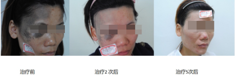 TopBull 济南丽合皮肤专科医院李伟主任带你认识胎记